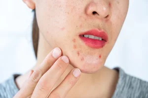 Can Acne Heal Naturally or Does It Require Treatment?