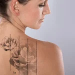 Tattoo Removal