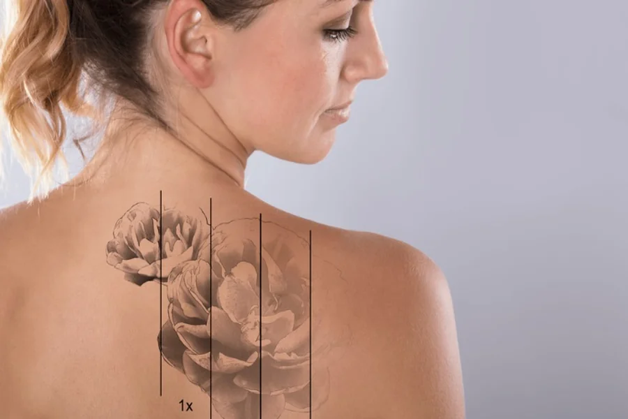 Tattoo Removal
