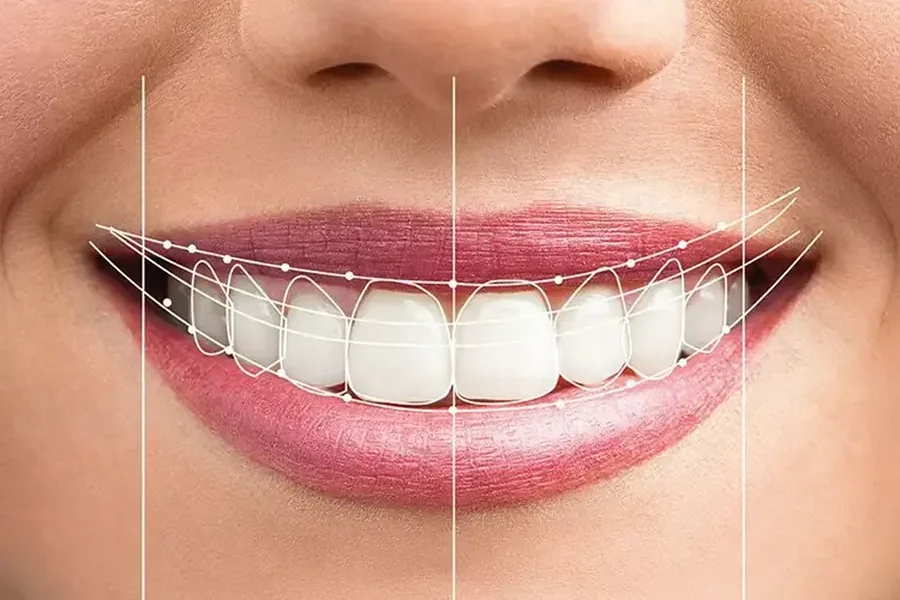 Full Mouth Rehabilitation