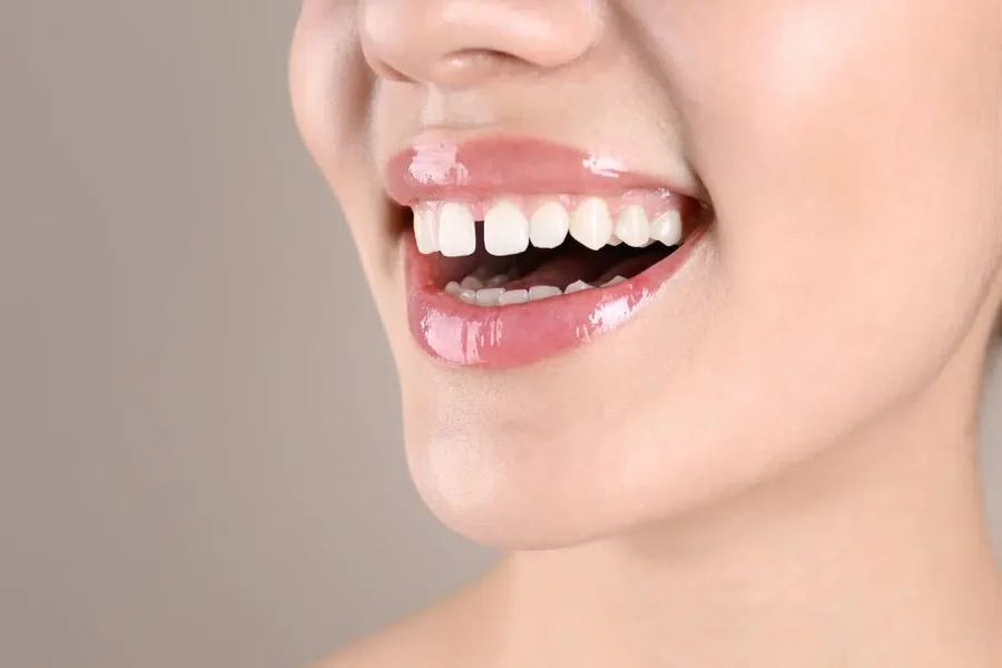 Teeth Gap Filling