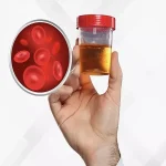 Blood in Urine (Haematuria): causes that should never be ignored