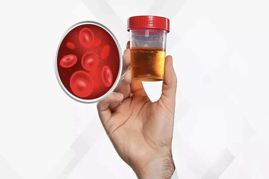 Blood in Urine (Haematuria): causes that should never be ignored